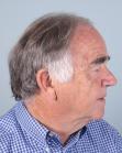 Before Hair Transplant&nbsp;Front